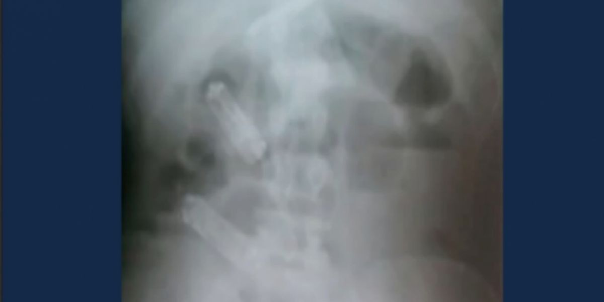 Zonacero.com En la imagen de este rayos X se observan los celulares en el estómago del recluso.