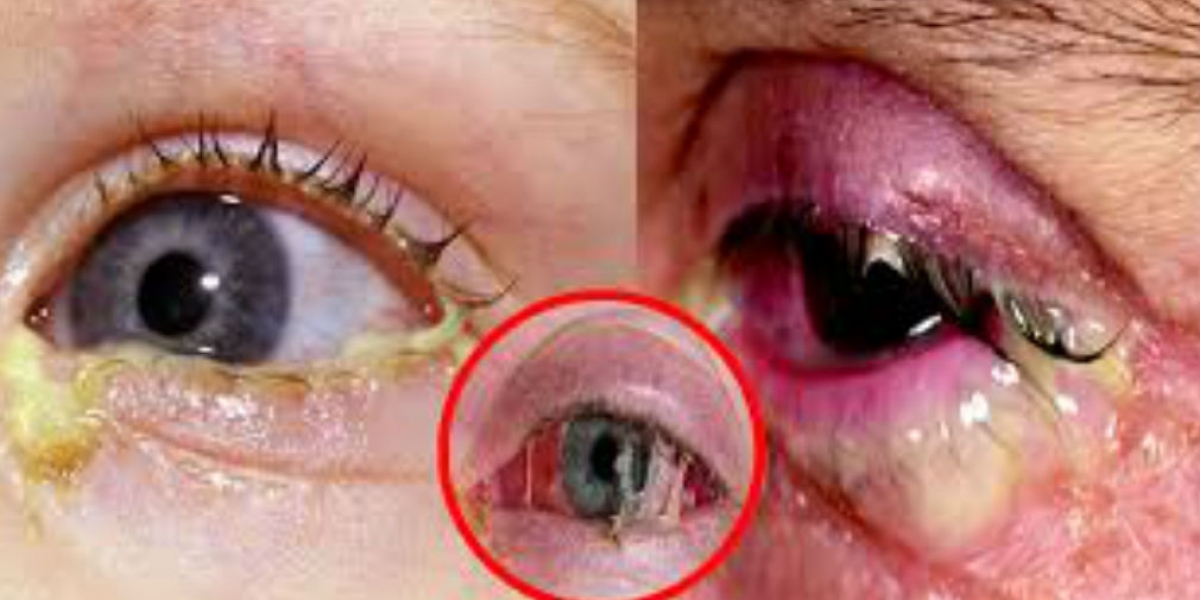Archivo. La conjuntivitis genera irritación de los ojos.