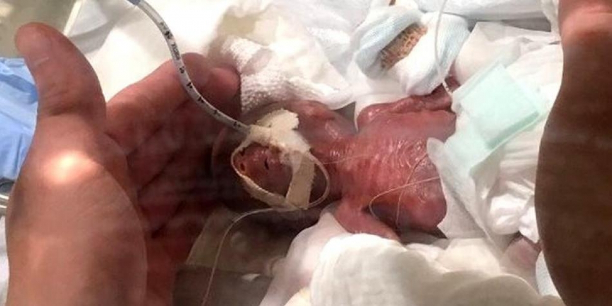 Keio University Hospital El bebé más pequeño del mundo