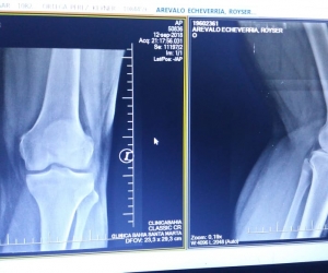 Lesión que sufrió Royser Arévalo tras caer de una grúa de tránsito del Distrito.